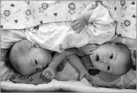 Conjoined babies waiting for surgery
